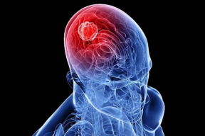 Как распознать рак мозга