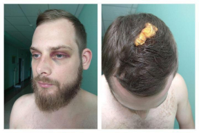 Сотрудника TUT.BY задержали за видео с мирных протестов – сломали ребро и разбили голову