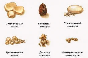 Уролог: камни в почках могут появиться, даже если постоянно есть только салатики